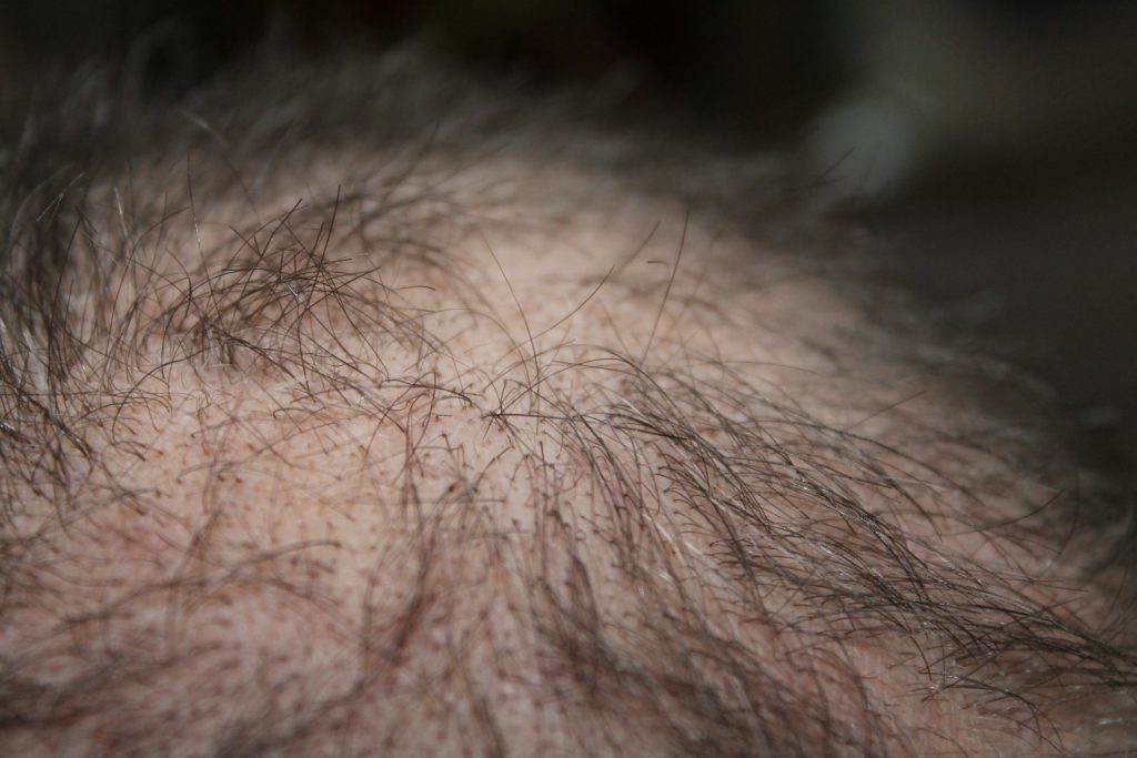 What Makes the Best Direct Hair Implant Procedure