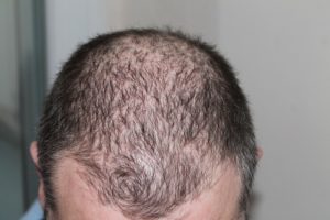 hair line