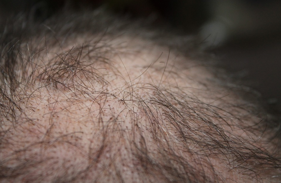 loosing hair